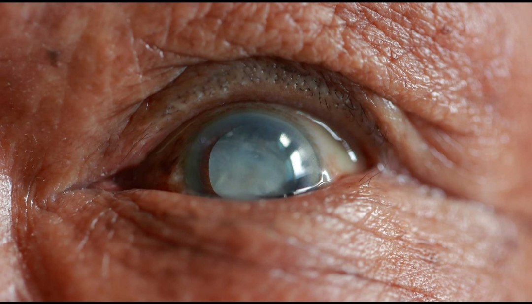 Cirugía de Cataratas